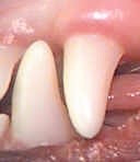 Incissors